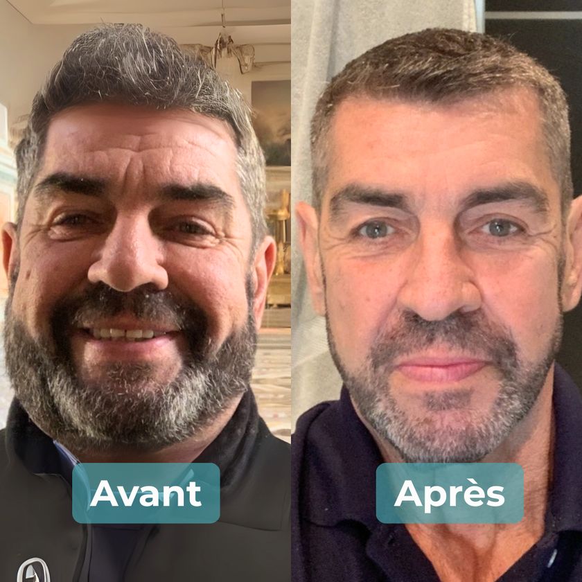 Photo avant et après un accompagnement MAbeautyplus