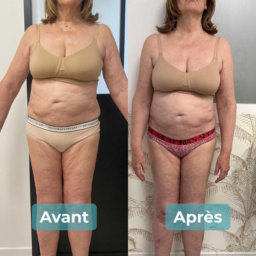 Photo avant et après un accompagnement MAbeautyplus